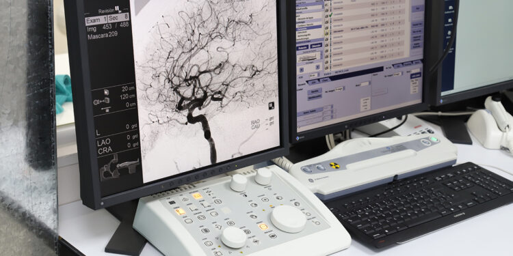 Especialistas llaman a prevenir accidentes cerebrovasculares 