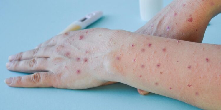 Seremi de Salud confirma primer caso de Mpox en Ñuble este 2025