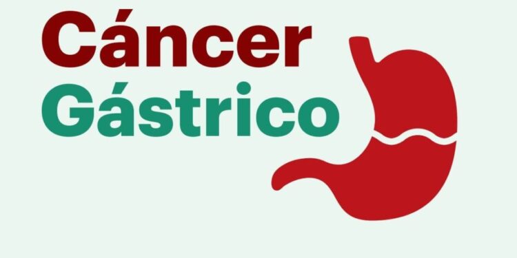 Se confirmaron 165 nuevos casos de cáncer gástrico en Ñuble