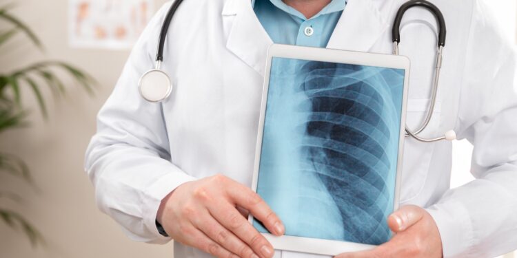 Día Mundial del Cáncer de Pulmón: Profesionales de salud refuerzan llamado a la prevención y diagnóstico oportuno