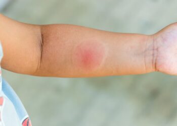 Servicio de Salud Ñuble refuerza llamado a prevenir picaduras e infecciones durante el verano