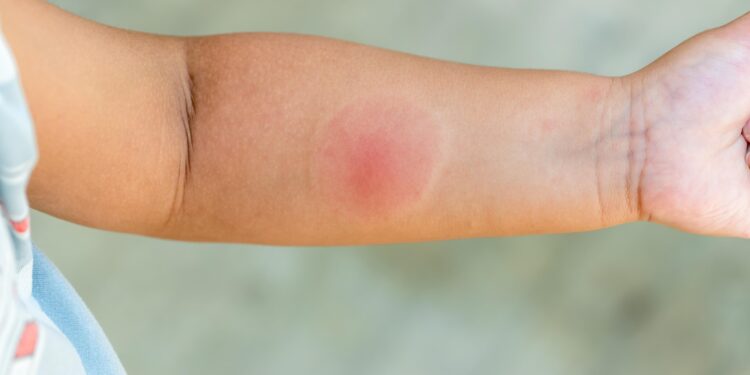 Servicio de Salud Ñuble refuerza llamado a prevenir picaduras e infecciones durante el verano